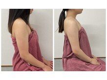 ブリランテ(Brillante)/継続4回beforeafter