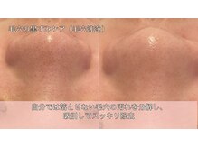 オーシャンブルー 時津店(OCEAN BLUE)/毛穴の黒ずみケア（毛穴洗浄）