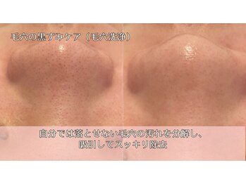 オーシャンブルー 時津店(OCEAN BLUE)/毛穴の黒ずみケア(毛穴洗浄)