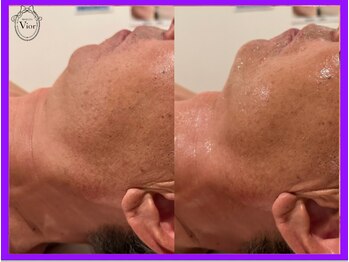 ヴィオール 名古屋栄店(VIOR)/あご肉撃退!小顔効果◎