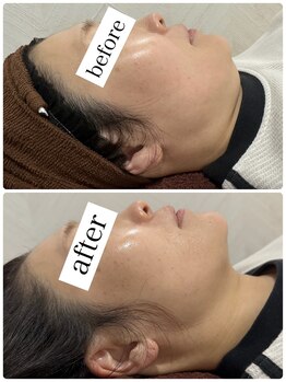 テイルズ(Tales)の写真/RED STOTで目覚める、ハリのある私!脂肪分解とエイジングケアで、ほうれい線・たるみ悩みにアプローチ☆