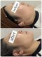テイルズ(Tales)の写真/RED STOTで目覚める、ハリのある私!脂肪分解とエイジングケアで、ほうれい線・たるみ悩みにアプローチ☆