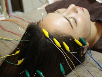 ミモザ(mimosa)/電気を流す鍼で小顔効果◎