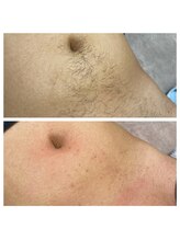 はだころも/メンズ お腹 wax脱毛