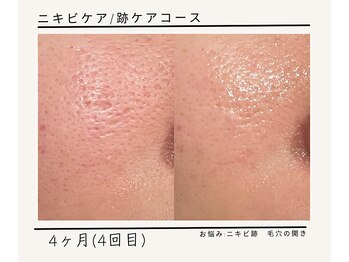 ルミエールフォートサイド(L’MIERE fortside)/お悩み:毛穴,跡