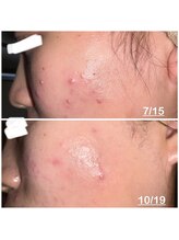 ミニョン(mignon)/モニター結果