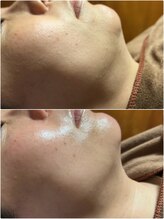 エステルーム クリスタル/レッドショットで二重顎を撃退！