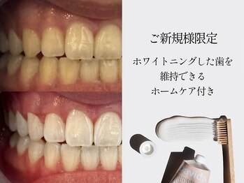 ナルムホワイトニング 代々木(NARUM whitening)の写真/【最新ホワイトニング】少ない痛みで劇的トーンアップ！食事制限なしでストレスフリーな美しい白い歯へ