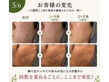 エステサロン ソワンの雰囲気（お肌のターンオーバーを早めて根本改善を目指しましょう！）