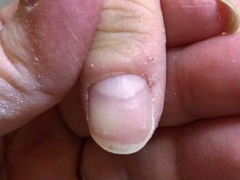 ネイルサロンアンドスクール シーグリーン(SEAGREEN)/【お悩み事例】手荒れによる赤み