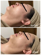 ジャスミン(Jasmin)/たるみ改善コース