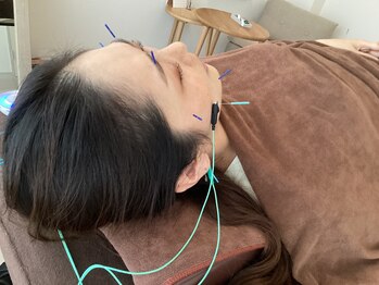 ハリファ鍼灸院 横浜関内院(HariFa鍼灸院)/美容施術/美容鍼