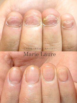 マリーロール 淀屋橋本店(Marie Laure)/自爪育成/深爪矯正/ネイルケア