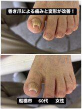 巻き爪じゅん 船橋店/巻き爪による痛みと変形が改善