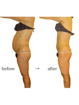 スタジオパルテ ネイルアイラッシュ(studio PARTE)/キャビテーション