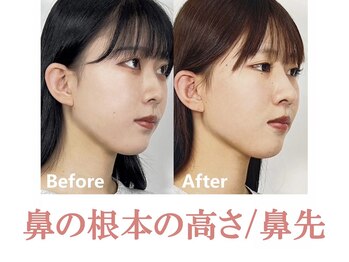 ラプリシュシュ 岡山店(Raplit)/ 隆鼻+輪郭矯正40分10回