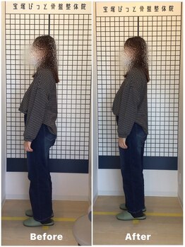 宝塚ぴっと骨盤整体院/産後の激しい腰痛