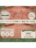 30日以内再来・顔ハーブピーリング剥離あり ヒト幹細胞導入 ¥15,000→¥13,000
