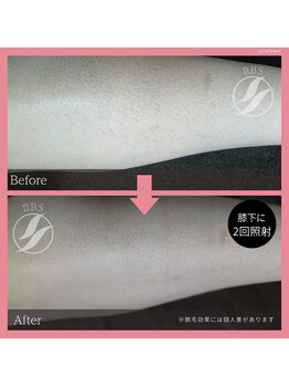 ブロンズ(BRONZE)/ひざ下