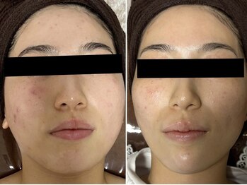 アキュセル ヨウコナース アンド 暢子美容鍼灸(Accu:Cell Youko nurse)/脂肪をとかす美容液　二十顎撃退