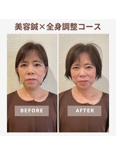 ベルソー鍼灸整体院(berceau鍼灸整体院)/美容はり×根本改善５０代女性