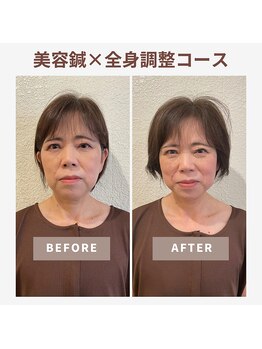 ベルソー鍼灸整体院(berceau鍼灸整体院)/美容はり×根本改善50代女性