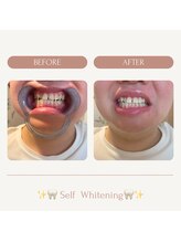 サロンエピ(Salon Epi)/セルフホワイトニング/烏丸御池