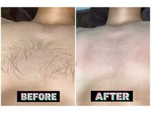 メンズスリーナインサロン(Men's ThreeNines Salon)/胸脱毛