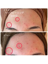 モアサロン(MOA salon)/ハーブピーリング3回目