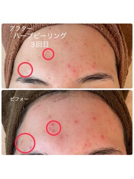 モアサロン(MOA salon)/ハーブピーリング3回目