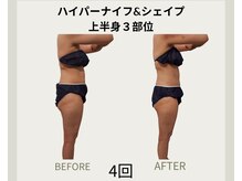 コリ チル(Kori Chill)/【ハイパーナイフ＆シェイプ】