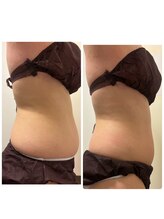 フォトビズ/レッドショットでお腹の脂肪分解