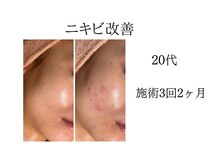 シャルナ(charna)/ニキビ改善