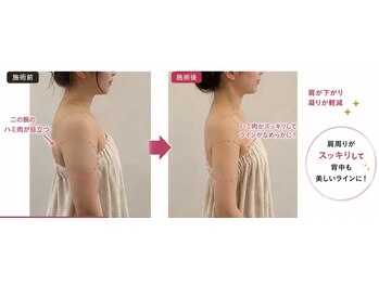 ビオール 新宿店(beall)の写真/【キャビ×ラジオ波×よもぎ蒸しトリプル痩身】二の腕・肩甲骨・お腹 ◎60分5800円　#本気で痩せたい方向け