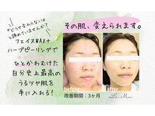 ラミーユ(La Miu)の雰囲気（最初は２週間に一回の集中ケアで改善が早いです！山科椥辻東野）