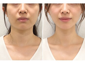 ドクターマジックタッチ(Dr.MAGIC TOUCH)の写真/ぼやけた輪郭・大きく見える顔が「え、こんなに？」憧れの劇的Vラインを目指す本気の小顔術

