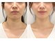 ドクターマジックタッチ(Dr.MAGIC TOUCH)の写真/ぼやけた輪郭・大きく見える顔が「え、こんなに？」憧れの劇的Vラインを目指す本気の小顔術


