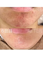 バーニー 梅田店(BARNEY)/ハーブピーリング