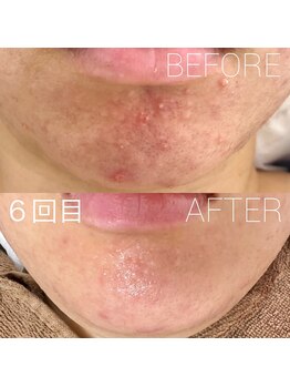 バーニー 梅田店(BARNEY)/ハーブピーリング