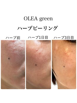 オレアグリーン 岡崎(OLEA green)/before after