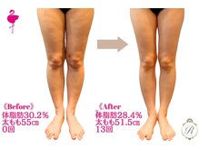 ルフレ(REFLET)/【事例8】Before/After/痩身