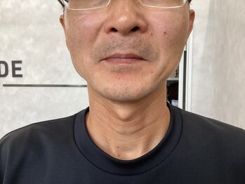 セルフメイド サンリブしみず店(SELFMADE)/ヒゲ　ビフォー