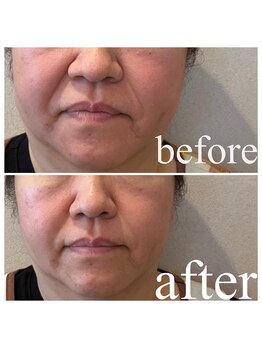 ディス イズ ミー エステティック(This is Me Aesthetic)/ほうれい線おまかせ下さい！