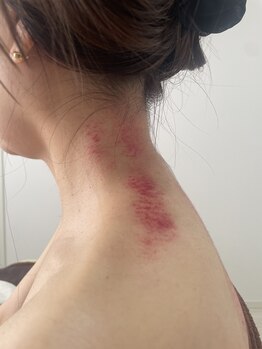 アノン(Anon)/中国式かっさ