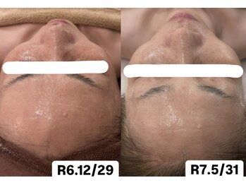 温オン(ON)/セルマンフェイシャル☆