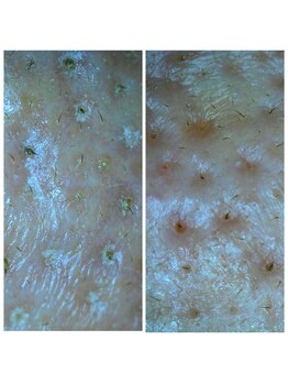 エヴァーグレース 河原町店/京都河原町の毛穴改善美肌サロン