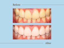 ルアナ(Luana)/初回Naturalメニュー 施術例