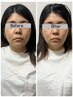 痛みの少ない小顔調整+最新美顔器【たるみ/むくみ/食いしばり/エラ】　60分