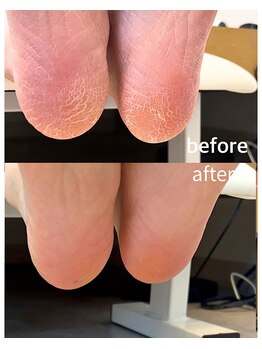 フットケアコース ¥6000