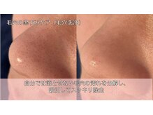 オーシャンブルー 時津店(OCEAN BLUE)/毛穴の黒ずみケア（毛穴洗浄）